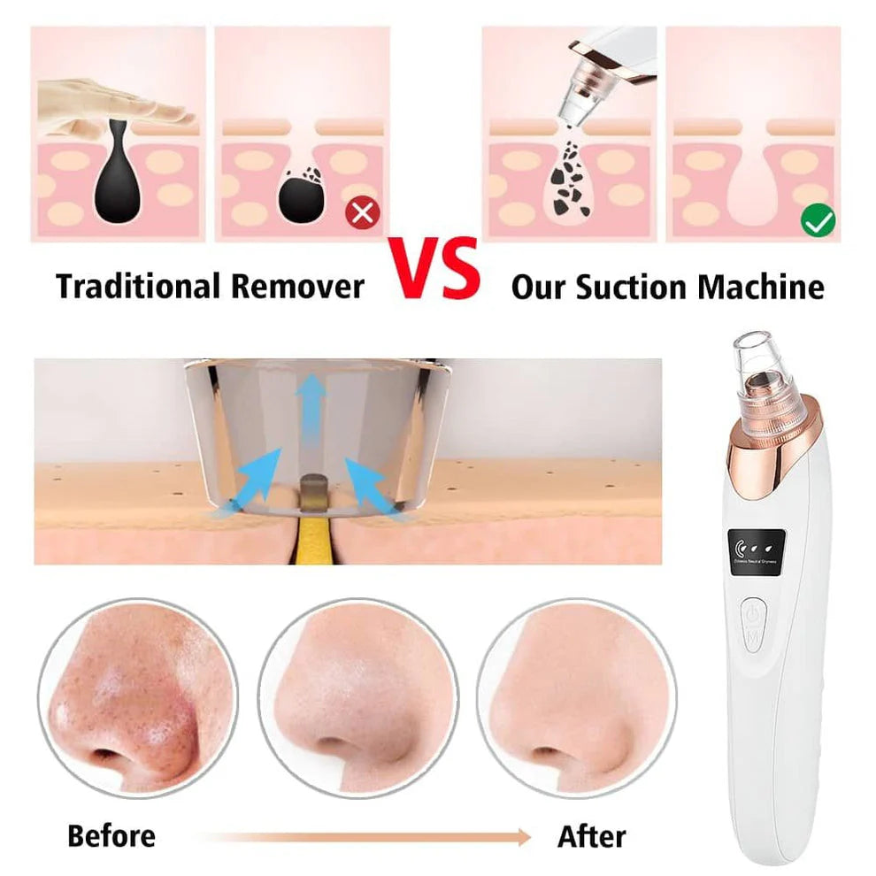 Facial Beauty - 5 in 1 Blackhead Remover Machine